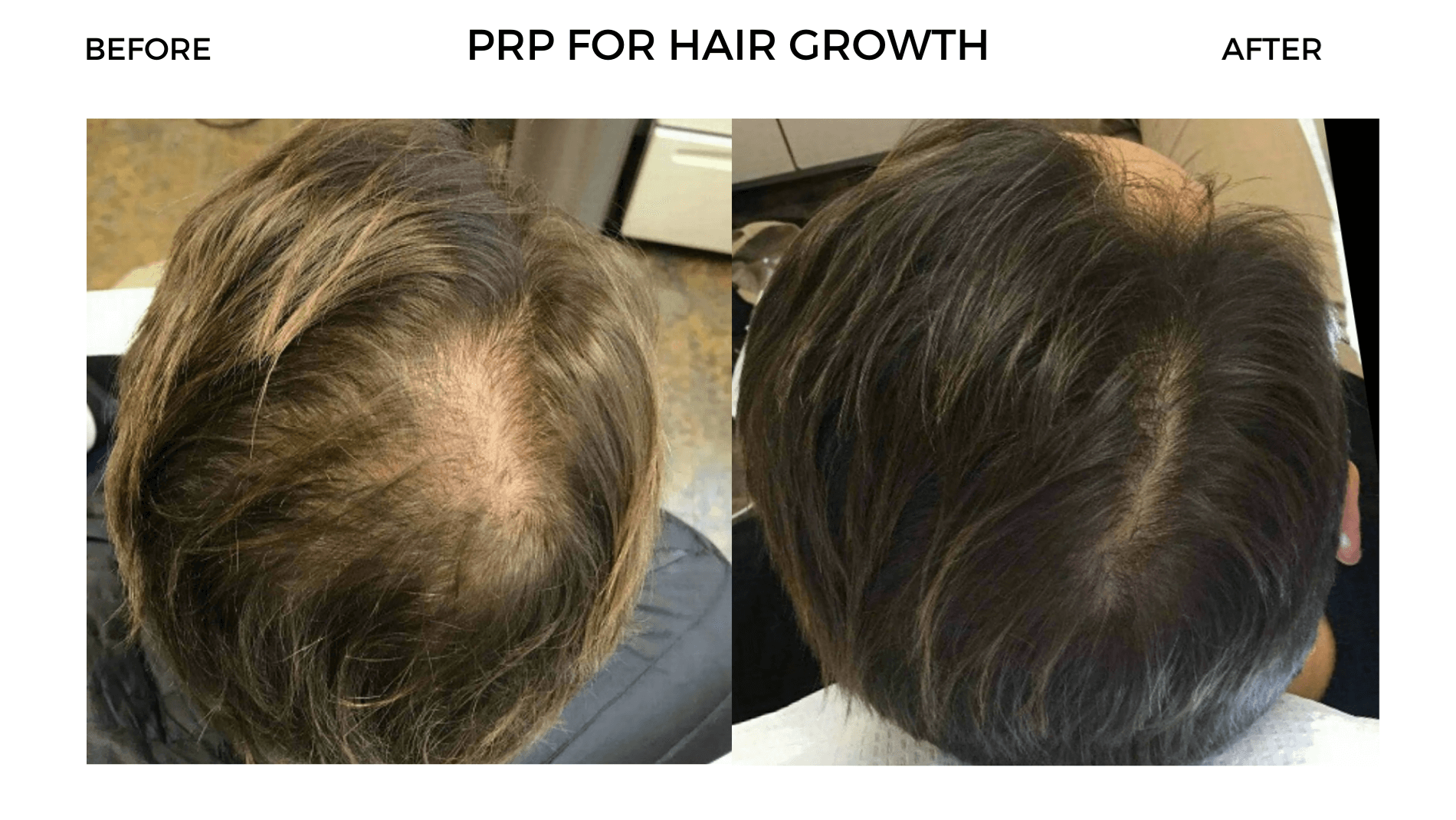 PRP Hair Growth